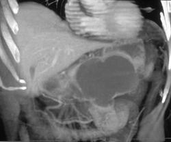 Pseudocyst - CTisus CT Scan