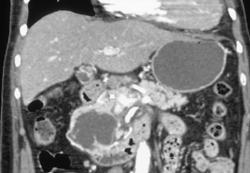 Cystadenoma of the Pancreas - CTisus CT Scan