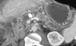 Chronic Pancreatitis - CTisus CT Scan