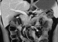 Pancreatic Cancer With Invasion of the Superior Mesenteric Artery (SMA) & Superior Mesenteric Vein (SMV) & Portal Vein - CTisus CT Scan