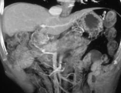 Carcinoma of the Pancreas With PV/SMV Invasion of Collaterals - CTisus CT Scan