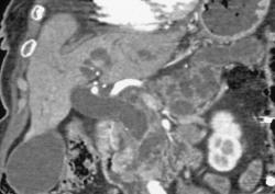 Intraductal Papillary Mucinous Neoplasm (IPMN) With Carcinoma - CTisus CT Scan