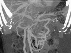 Pancreatic Cancer Encases the PV/SMV - CTisus CT Scan