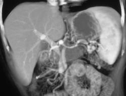 Pancreatic Cancer Encases the Splenic Artery - CTisus CT Scan