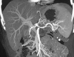 Encasement of the Splenic Artery and Vein With Collaterals - CTisus CT Scan