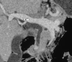 Ampullary Cancer on VRT & Mini IP Images - CTisus CT Scan