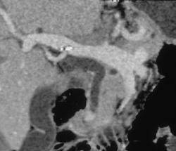 Volume Visualization of the Common Bile Duct and Portal Vein - CTisus CT Scan