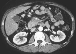 Pancreatic Cancer - CTisus CT Scan