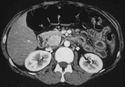 Gastrinoma With Thickened Gastric Folds - CTisus CT Scan