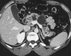 Von Hippel Lindau With Cystadenoma Pancreas - CTisus CT Scan