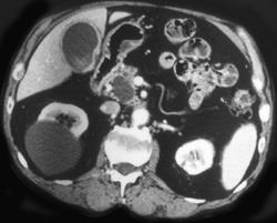 Pseudocyst - CTisus CT Scan