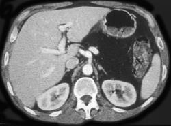 Cystic Fibrosis With Fatty Replaced Pancreas - CTisus CT Scan