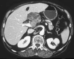 Nodes in Porta Hepatis Simulates A Pancreatic Mass - CTisus CT Scan