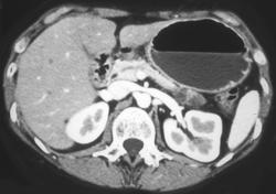 Resolving Pseudocyst in the Pancreatic Tail - CTisus CT Scan