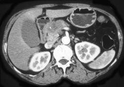 Pancreatic Cancer - CTisus CT Scan