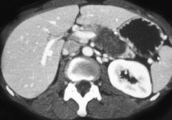 Necrotic Tumor of the Tail of the Pancreas - CTisus CT Scan