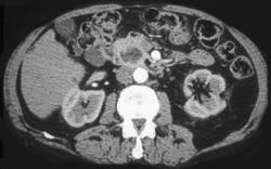 Necrotic Adenocarcinoma of the Pancreas - CTisus CT Scan