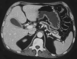 Pancreatic Cancer With Dilated Pancreatic Duct - CTisus CT Scan