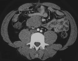 Pancreatic Cancer - CTisus CT Scan