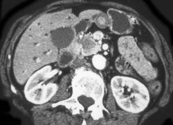 Pancreatic Cancer With Dilated Common Bile Duct (CBD) - CTisus CT Scan