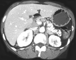 Chronic Pancreatitis - CTisus CT Scan