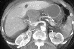 Nodes in Porta Hepatis Simulate A Pancreatic Cancer - CTisus CT Scan