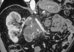 Adenocarcinoma Arising in Intraductal Papillary Mucinous Neoplasm (IPMN) and Encases the SMA - CTisus CT Scan