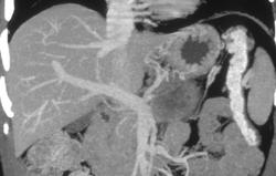 Pancreatic Cancer of the Tail of the Pancreas Occludes the Splenic Vein - CTisus CT Scan