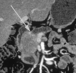 Pancreatic Cancer Obstructs Pancreatic Duct - CTisus CT Scan