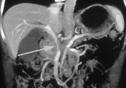 Pancreatic Cancer Invades the Portal Vein With Collaterals - CTisus CT Scan