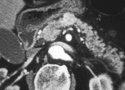 Insulinoma - CTisus CT Scan