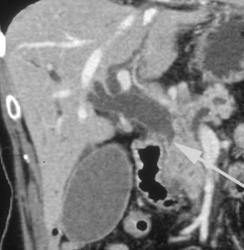 Encased Distal Common Bile Duct (CBD) Due to Pancreatic Cancer - CTisus CT Scan