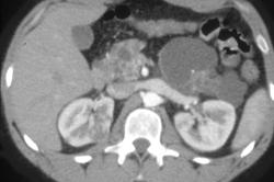 Von-hippel Lindau With Renal Cell Carcinoma and Cystic Pancreatic Tumor - CTisus CT Scan