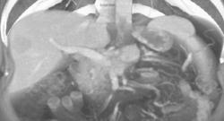 Pancreatic Cancer Invades the Portal Vein With Liver Metastases - CTisus CT Scan