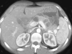 Multiple Cysts in Pancreas - CTisus CT Scan