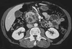 Pancreatic Cancer - CTisus CT Scan