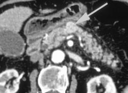 Insulinoma - CTisus CT Scan