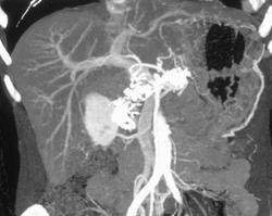 Chronic Pancreatitis - CTisus CT Scan