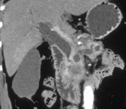 Pancreatic Cancer Obstructs the Common Bile Duct (CBD) and Pancreatic Duct - CTisus CT Scan