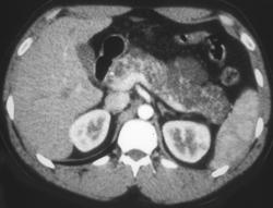 Cystadenoma Pancreas and Renal Cancer - Von Hippel-Lindau syndrome (VHL) - CTisus CT Scan