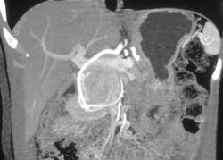 Islet Cell Tumor - CTisus CT Scan