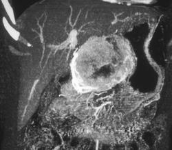 Islet Cell Carcinoma of the Pancreas in 3D Angiography - CTisus CT Scan