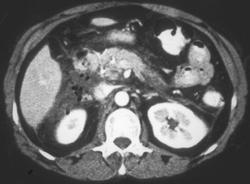 Pancreatitis Post-ERCP - CTisus CT Scan