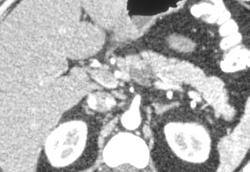 Intraductal Papillary Mucinous Neoplasm (IPMN) - CTisus CT Scan