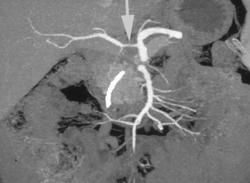 Cancer of the Pancreas Invades the Hepatic Artery - CTisus CT Scan