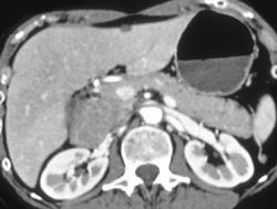 Nodes Simulate A Pancreatic Mass - CTisus CT Scan