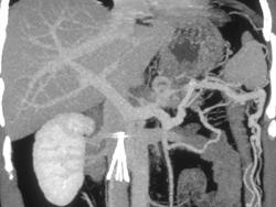 Collateral Vessels Due to Splenic Vein Occlusion - CTisus CT Scan