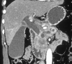 Pancreatic Cancer Obstructs the Common Bile Duct - CTisus CT Scan