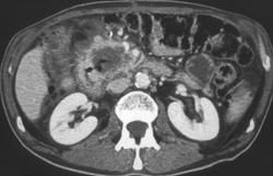 Fistulae From Duodenum to Pancreas - CTisus CT Scan