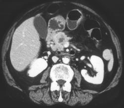 Pancreatic Cancer - CTisus CT Scan